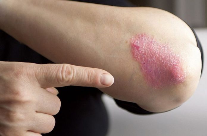 nuova cura psoriasi reggio calabria