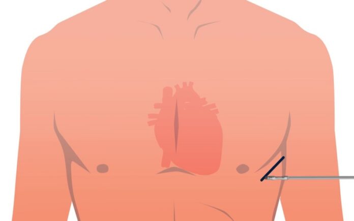 Annunziata Cosenza impianto defibrillatore automatico