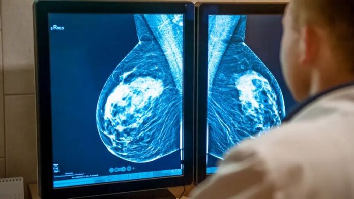 cancro seno radiografia