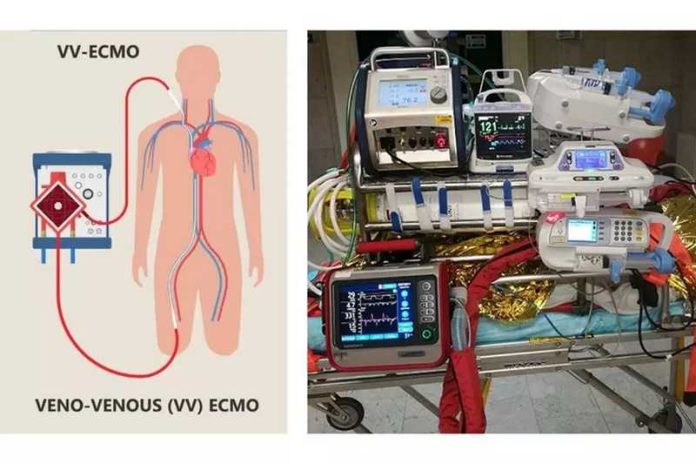 ecmo