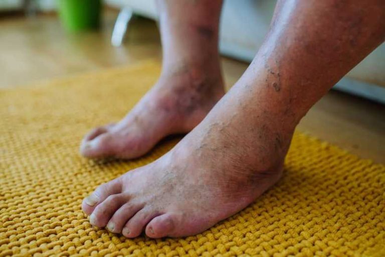 piede diabetico